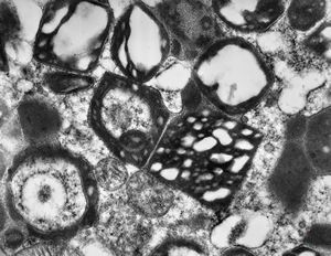 M,58y. | crystalline inclusions in hepatocyte after unknown medication